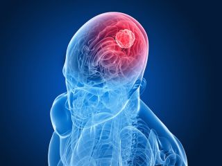 Brain Tumor Surgery in India