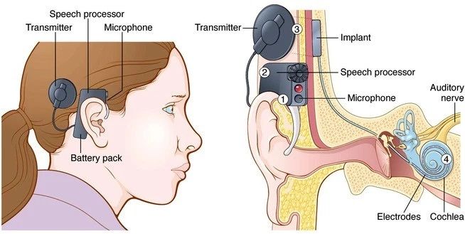 cochlear implant surgery cost In India