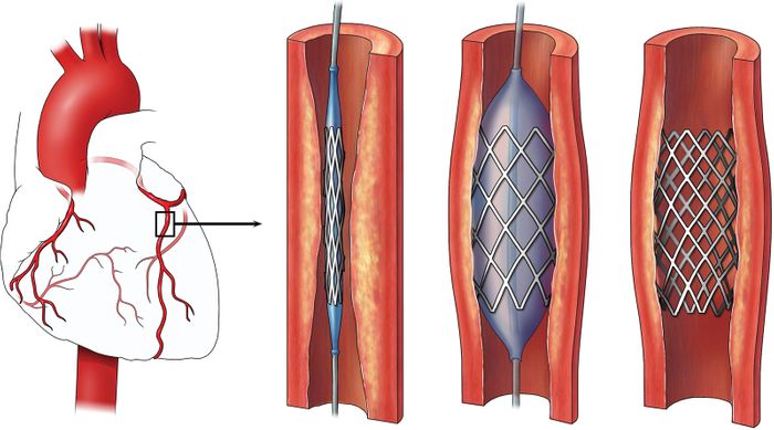 Angioplasty Cost, Procedure, risks, and recovery in India