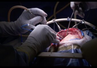 Best Craniotomy Surgery Cost in India