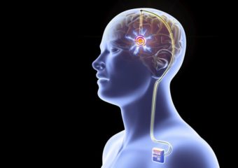 Deep Brain Stimulation surgery In India