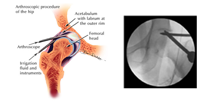 Low-Cost Best Hip Arthroscopy Surgery In India.