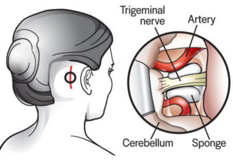 Microvascular Decompression