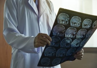 Brain Shunt surgery in india