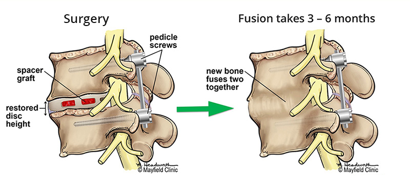 Spinal-fusion surgery cost in India
