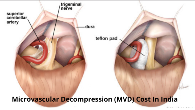 Best Microvascular Decompression (MVD) Cost In India