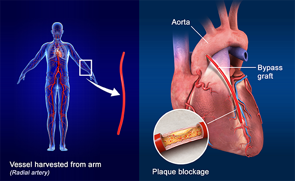 Coronary Artery Bypass Grafting ( Cabg) surgery In India