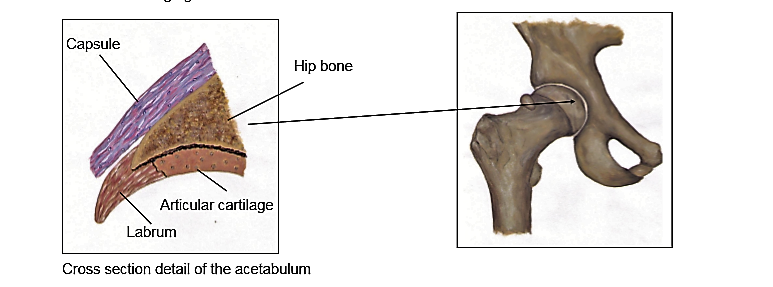 Repetitive impact, trauma or arthritis of the hip joint causes a gradual loss of cartilage which in some cases can lead to debilitating pain and loss of sleep. In patients with sufficient remaining cartilage micro-fracture can be performed, which involves making small holes through the surface layer of bone (subchondral bone) to increase blood flow from deeper, vascularised bone and help stimulate cartilage growth.