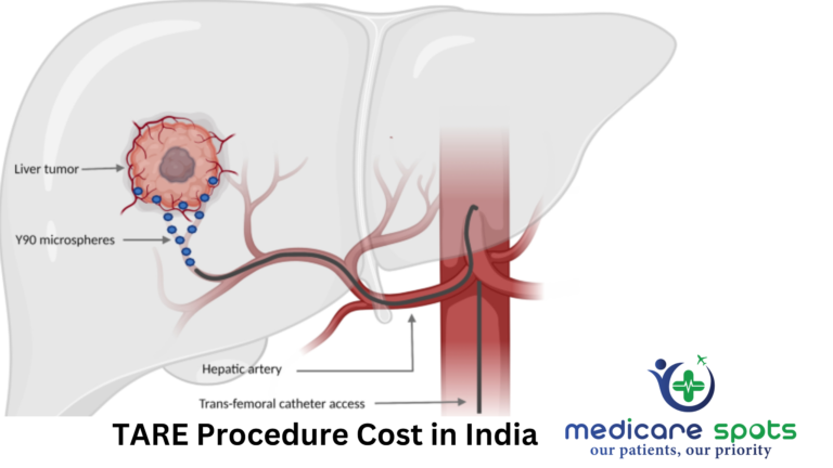 TARE Procedure Cost in India