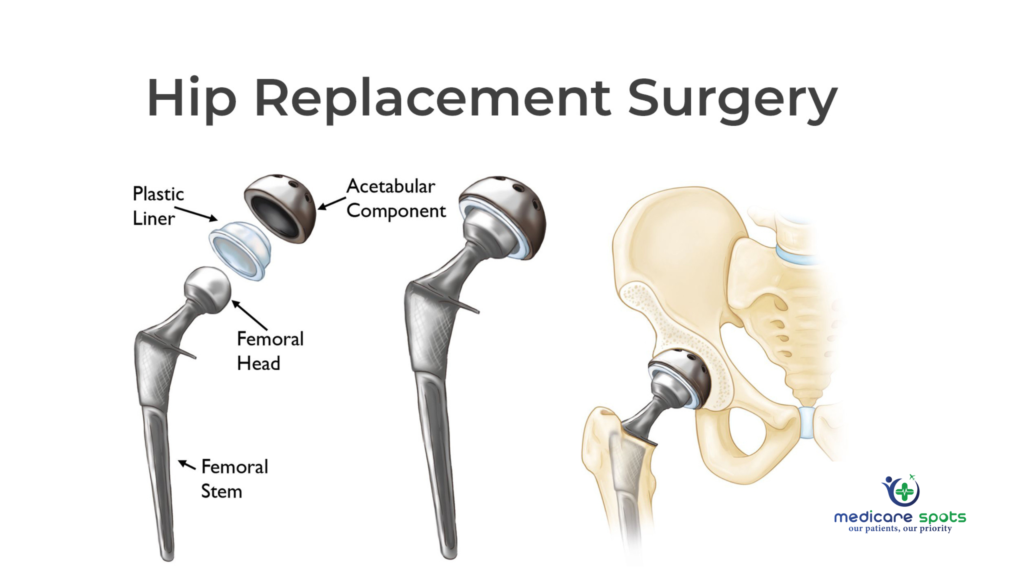 Hip Replacement Surgery
