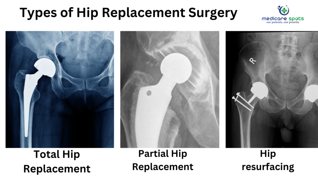Types of Hip Replacement Surgery: